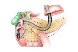 ERCP & Hepatobiliary interventions