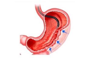 Endoscopic Sleeve Gastroplasty