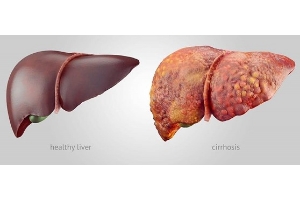 Liver diseases & Management